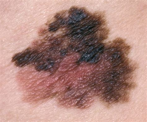 images of skin melanoma